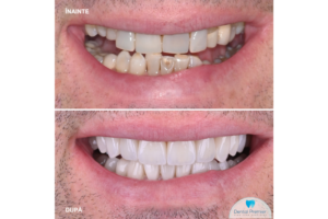 Cum era implantul dentar atunci și cum e acum? Mai multe aici despre experiența pacientului